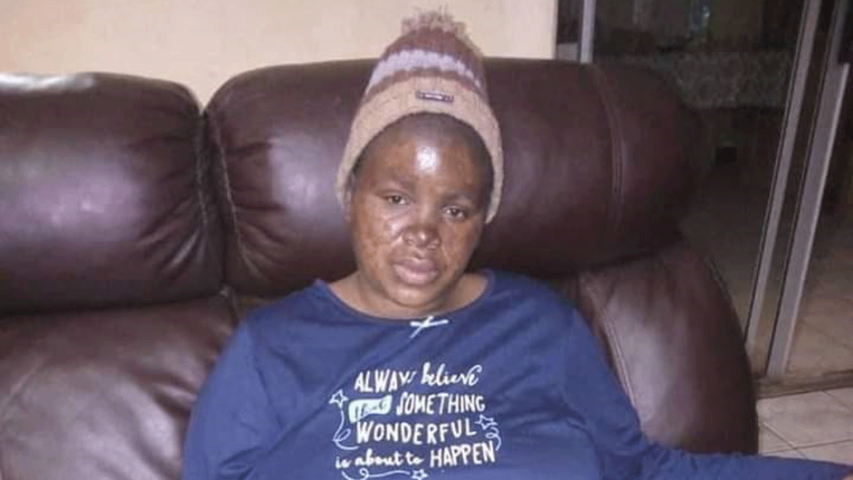 Lupus, “The Disease with a Thousand Faces”